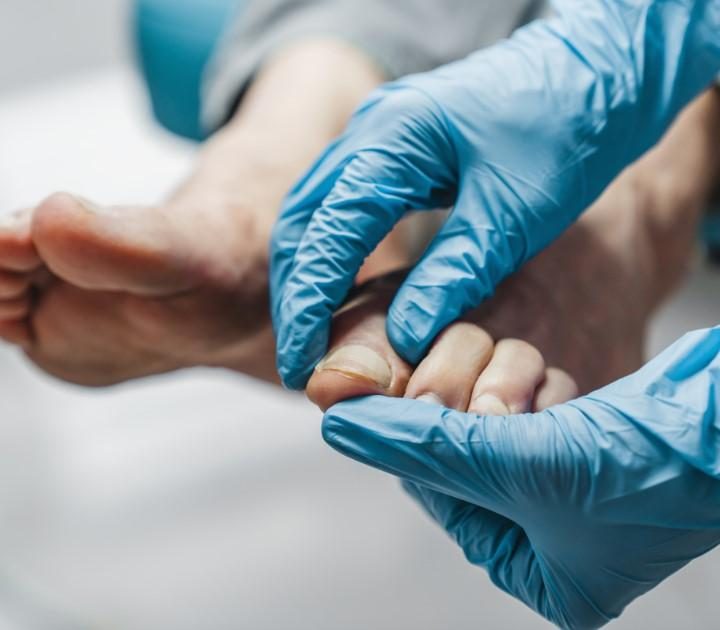 Hammertoe condition and foot treatment
